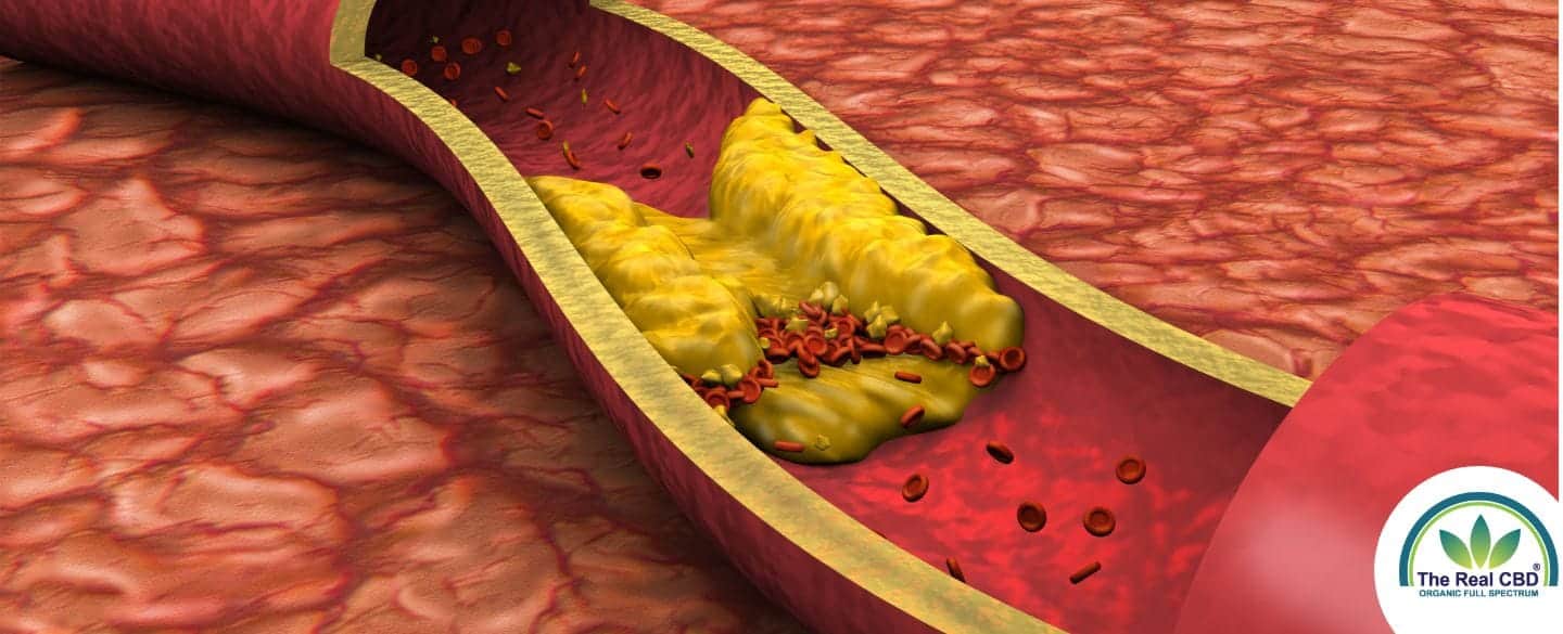 Drawing of a clogged artery
