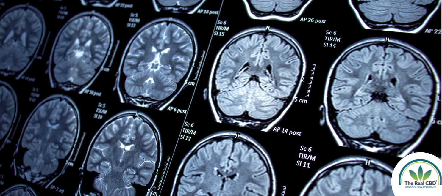 Lots of brain scan pictures