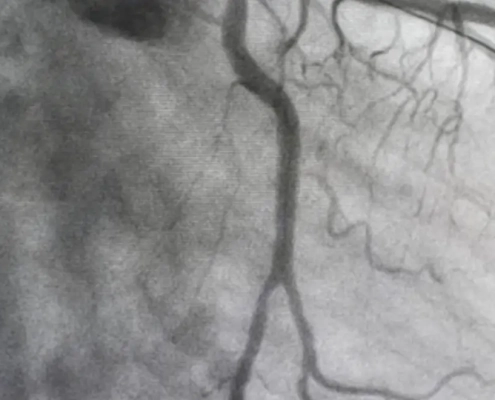 Black and white scan of someone's veins