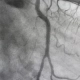 Black and white scan of someone's veins