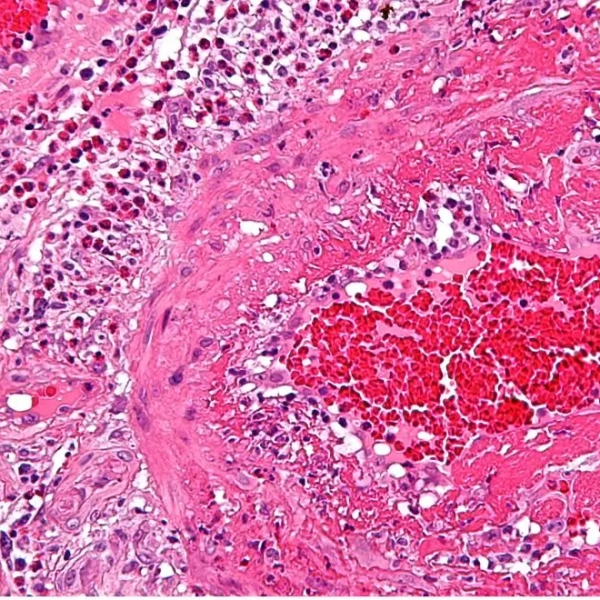 Pink picture of the inflammation seen through a microscope