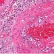Pink picture of the inflammation seen through a microscope