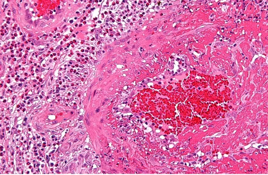 Pink picture of the inflammation seen through a microscope