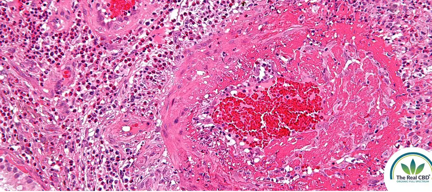 Pink picture of the inflammation seen through a microscope