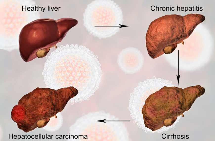 Illustration of fatty liver disease