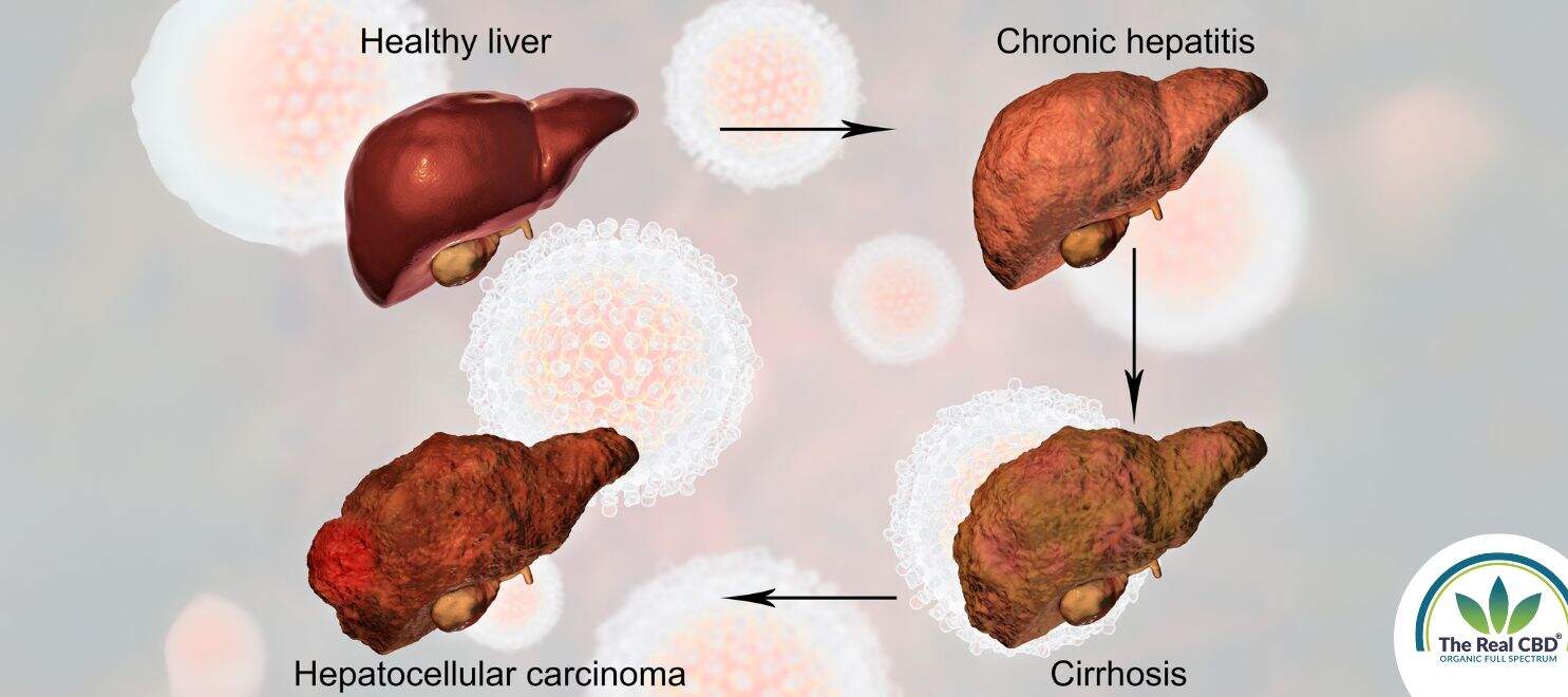 Illustration of fatty liver disease