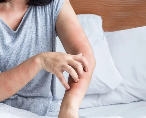 Woman scratching her arm with a red rash