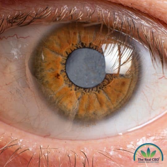 Close-up of an eye with cataracts