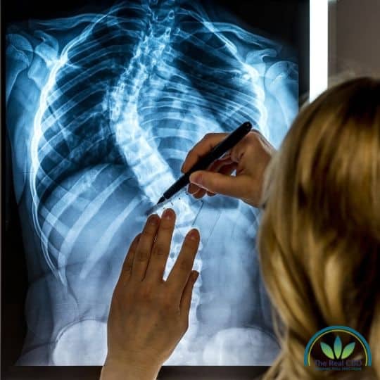 Doctor looking at an x-ray of a scoliosis spine