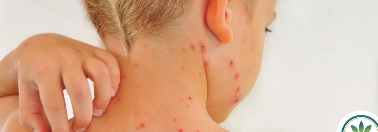 Boy seen from his back and he is itching his red spots
