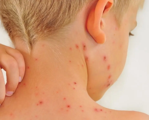 Boy seen from his back and he is itching his red spots