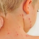 Boy seen from his back and he is itching his red spots