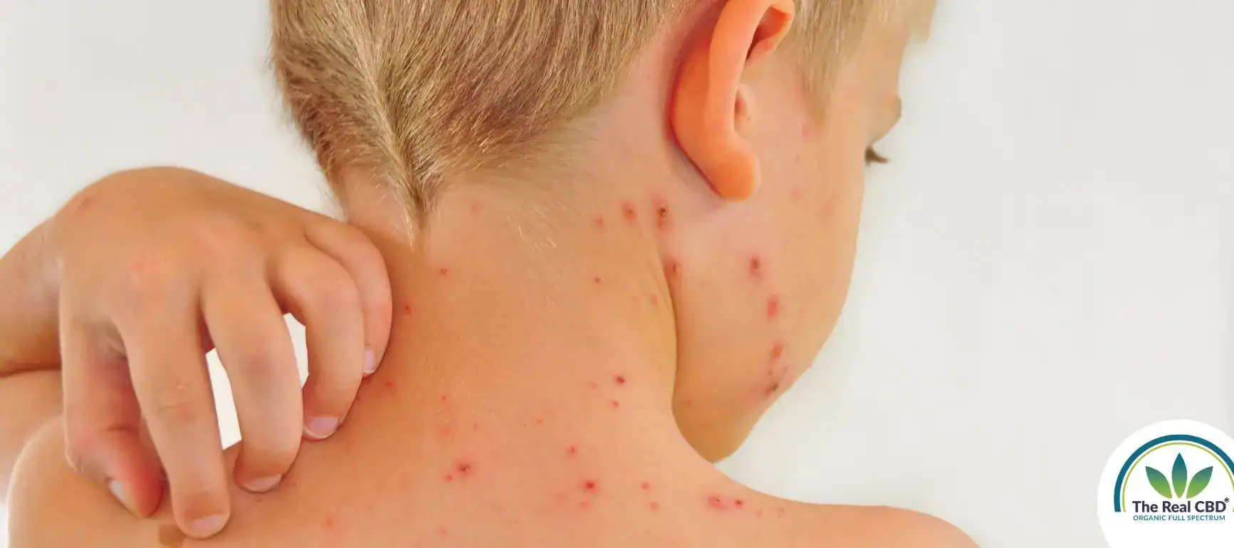 Boy seen from his back and he is itching his red spots