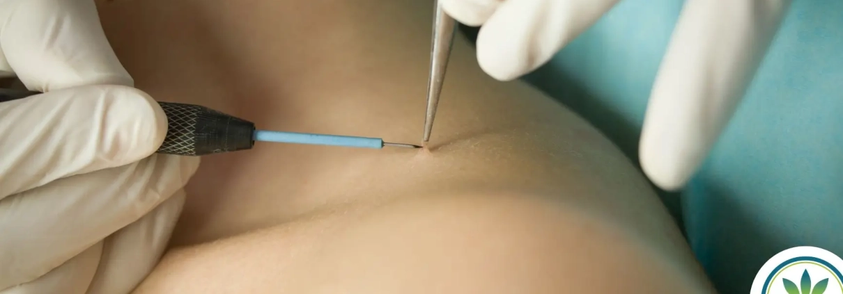 Person having a skintag removed