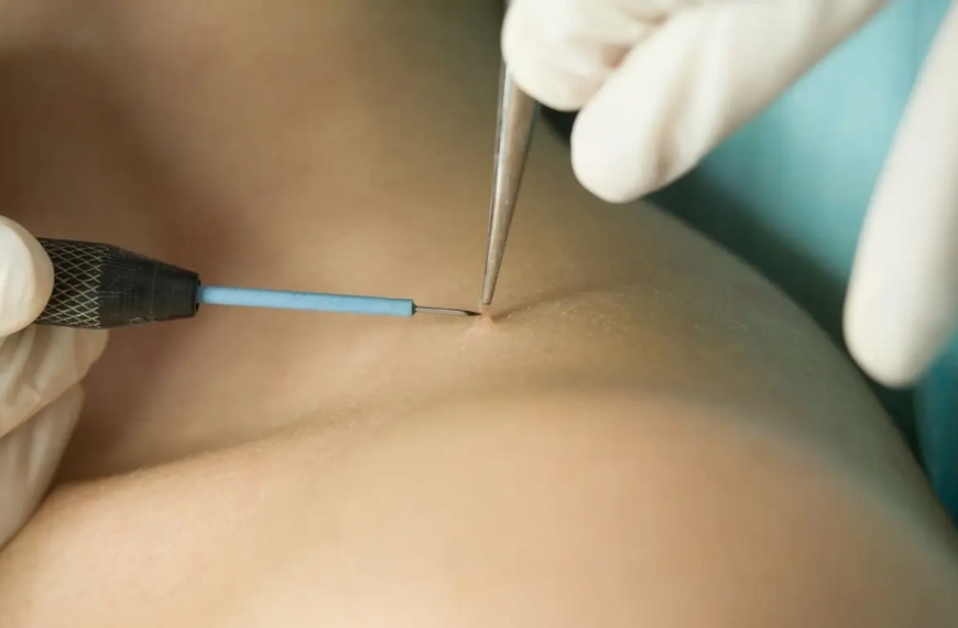 Person having a skintag removed